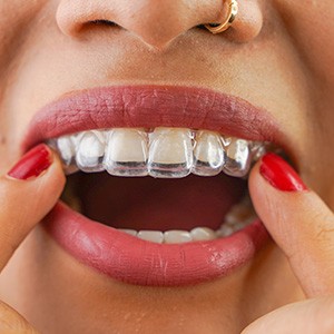 Patient putting on clear aligner