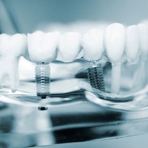 Two dental implants in transparent model jaw anchoring dental bridge