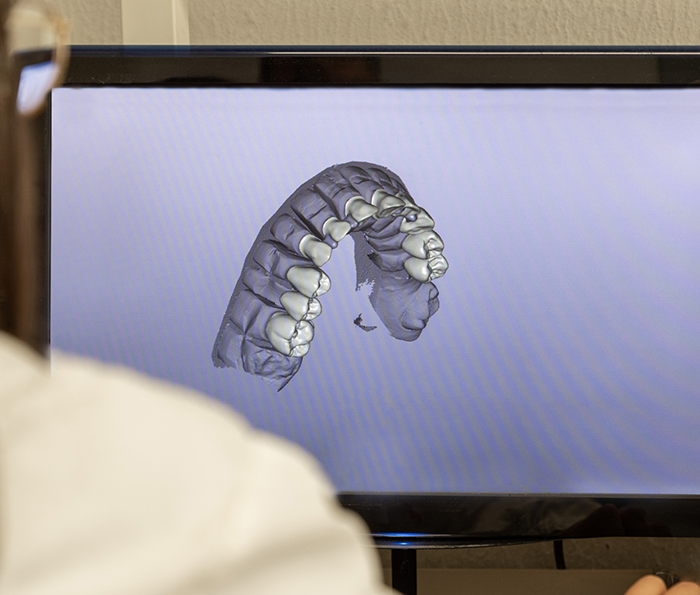 Screen showing a digital model of an arch of teeth