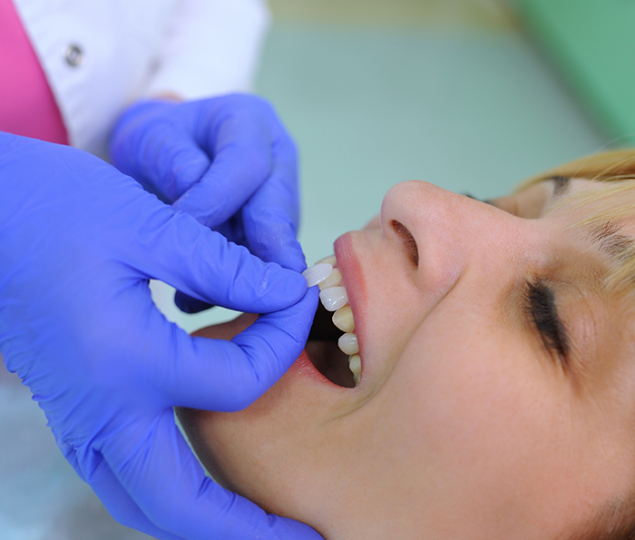 Dentist placing a veneer over a patients tooth