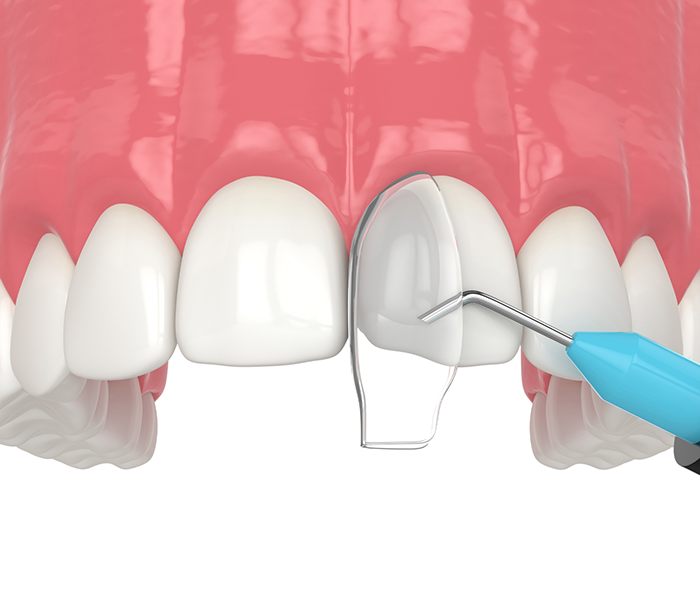 Illustration of dental bonding material being applied to a chipped tooth
