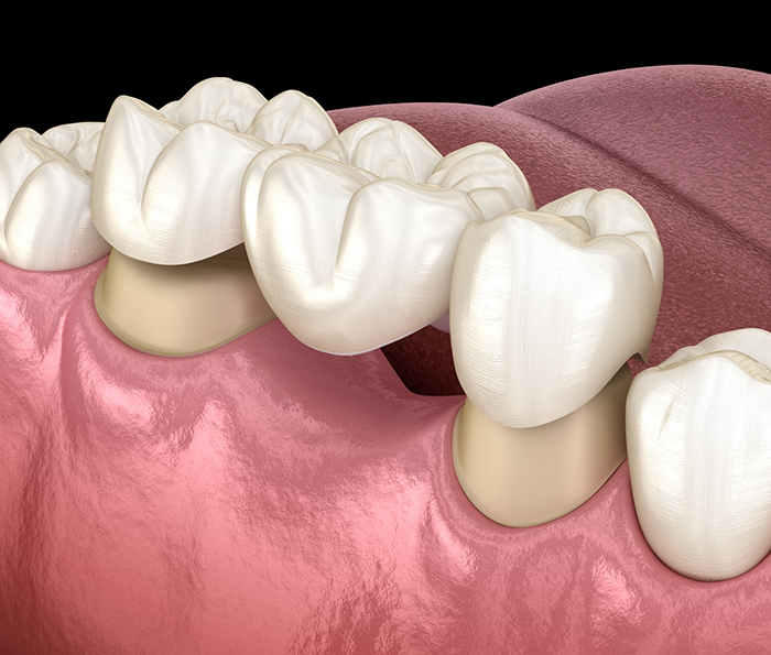 Illustration of a dental bridge replacing a missing tooth