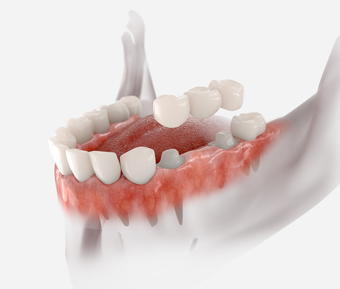 Model of a dental bridge being fitted over two teeth to fill the gap between them