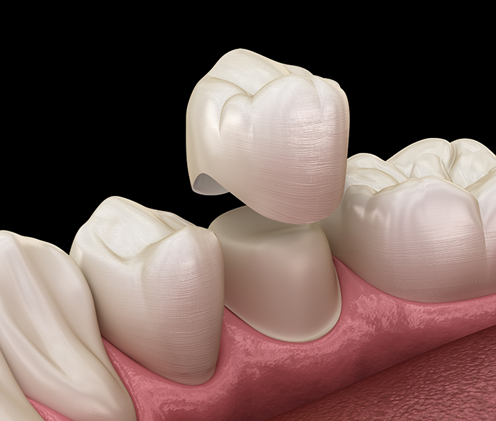 Illustration of a dental crown being fitted over a tooth