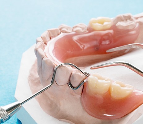 Set of partial dentures on cast of lower arch