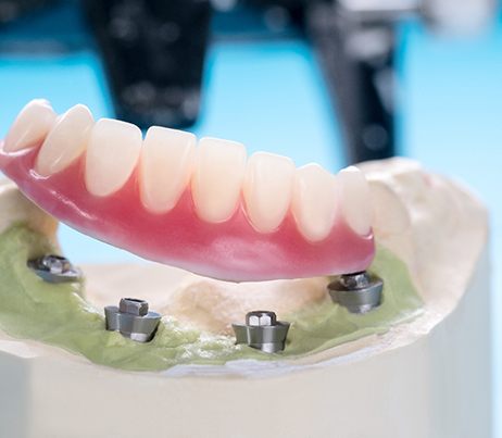 Lower arch of dentures on cast of jaw with 4 implant posts