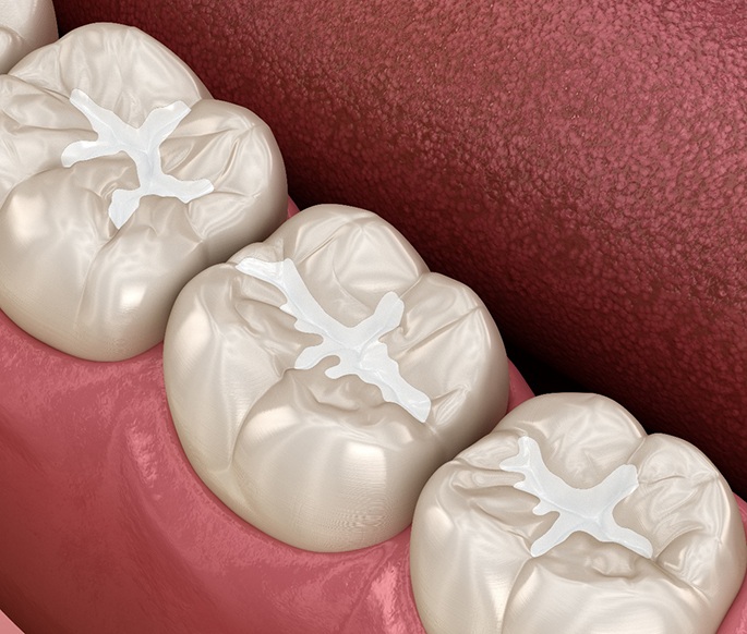 Rendering of 3 teeth with tooth-colored fillings