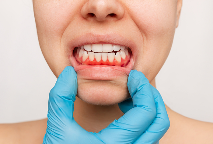Close up of a person with red gums before gum disease treatment in Salmon Creek