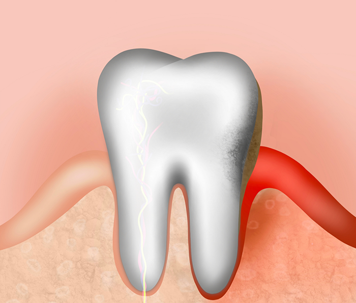 Illustration of a tooth with healthy gums on one side and inflamed receding gums on the other
