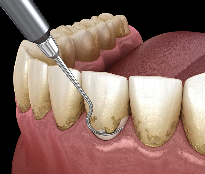 Illustrated dental scaler clearing plaque buildup from teeth