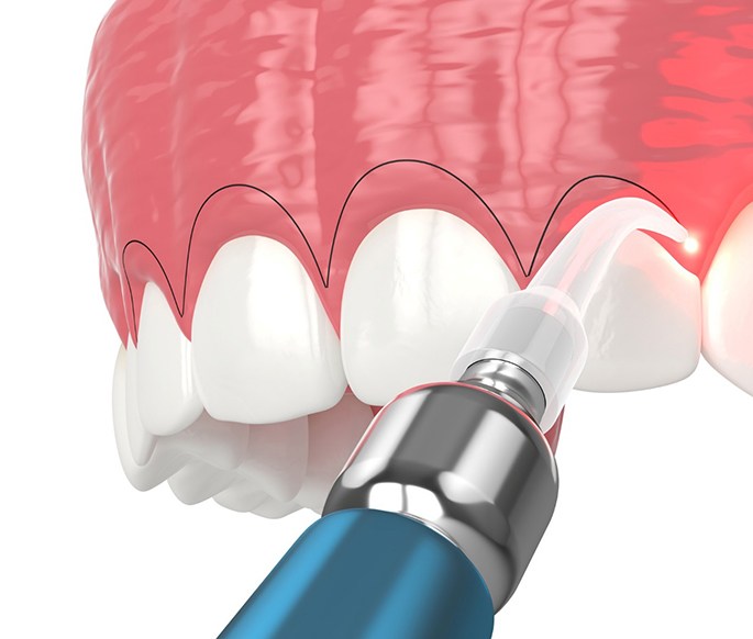 Digital image of gum recontouring