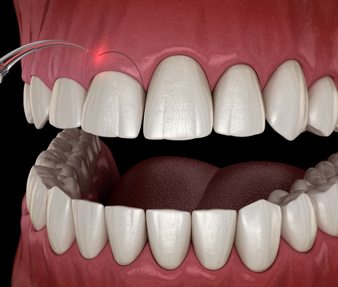 Digital rendering of the gum recontouring process