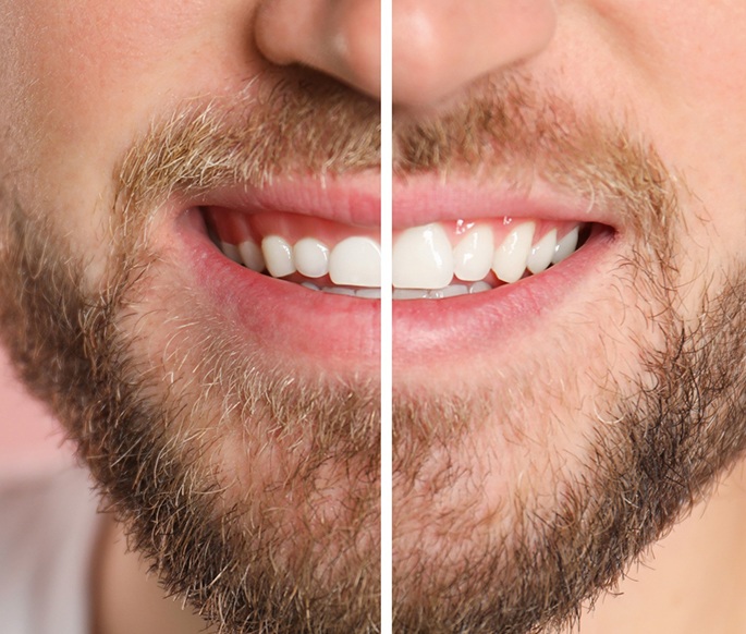 Before and after image of a man’s smile with gum recontouring