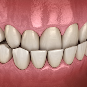 Example of underbite in Salmon Creek