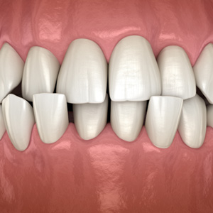 Example of open bite in Salmon Creek