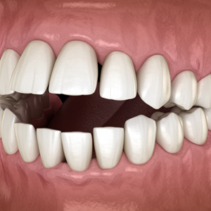 Example of open bite in Salmon Creek