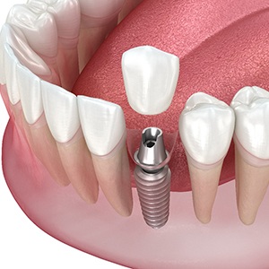 Illustration of single dental implant