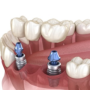 Illustration of implant bridge