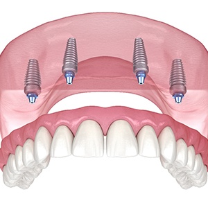 Illustration of an implant denture