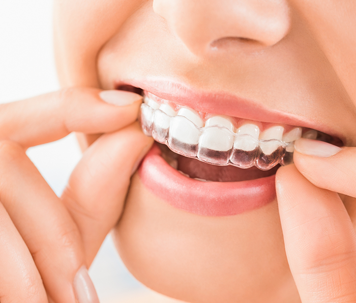 Close up of a person placing a clear aligner over their teeth