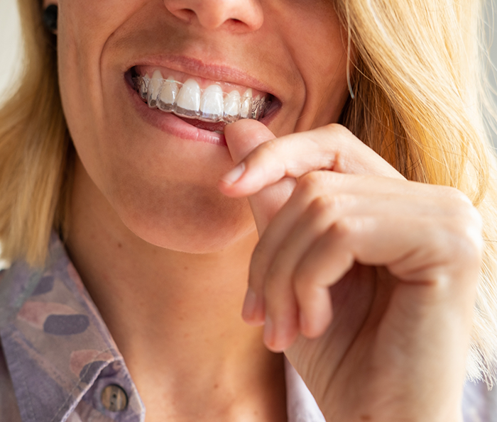Woman placing a clear aligner over her teeth