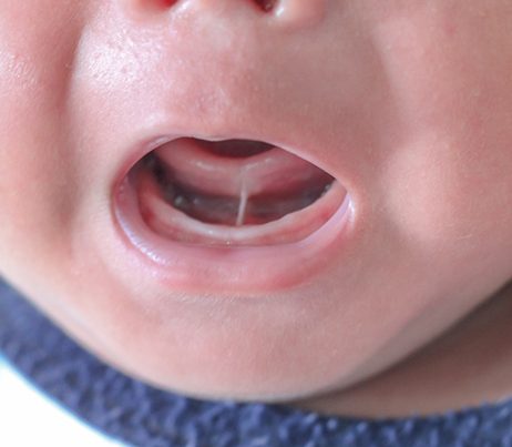 Closeup of a tongue-tie