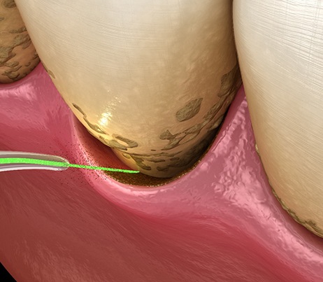 Illustration of laser gum disease treatment