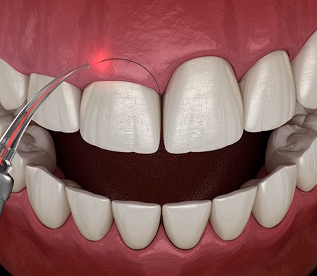 Illustration of gum recontoruing