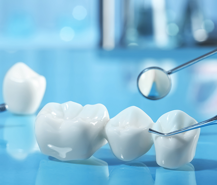 Dental bridge with a dental mirror