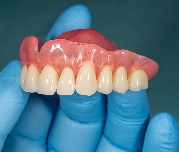 Gloved hand holding a full upper denture
