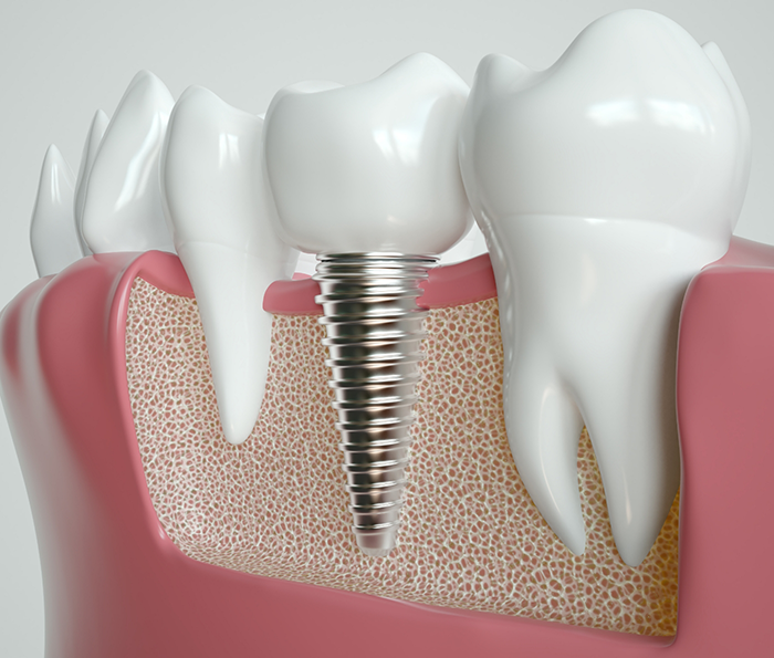 Illustrated dental implant in the lower jawbone
