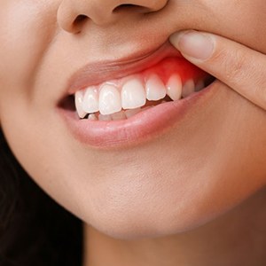 a woman showing signs of gum disease