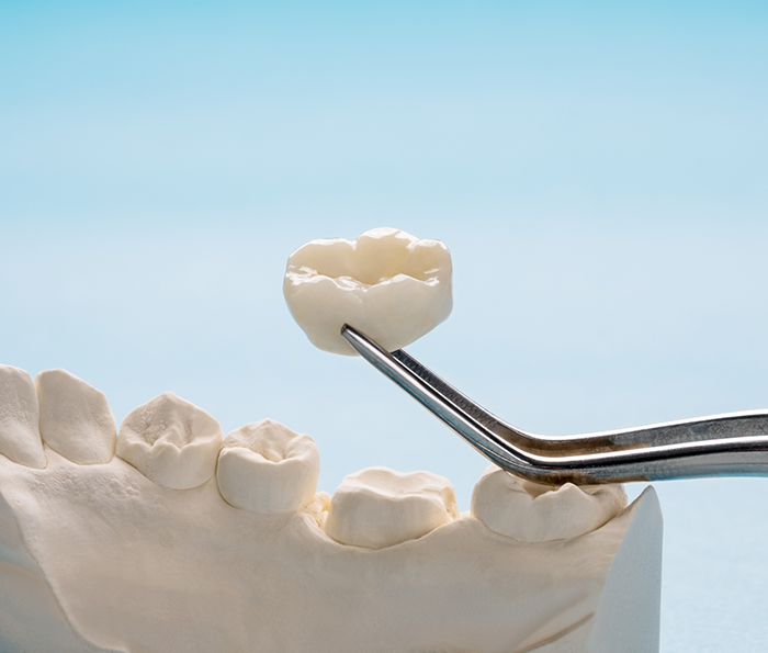 Tweezers holding a dental crown