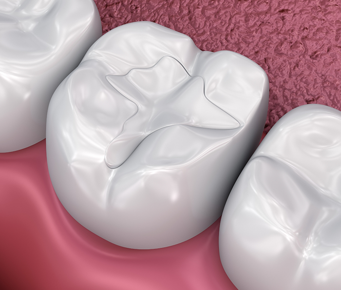 Illustrated tooth with a white filling