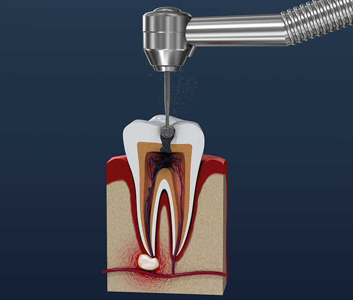 Illustration of a dental instrument treating the inner layer of an infected tooth