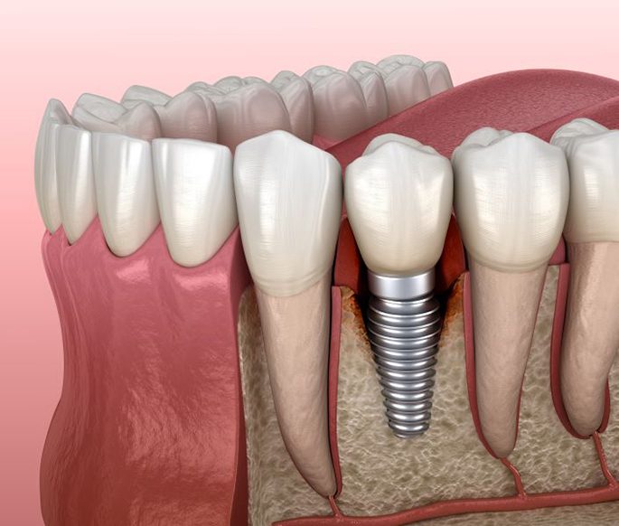 Peri-implantitis infection around a dental implant