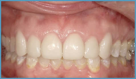 Close up of mouth with evenly aligned teeth