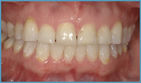Close up of mouth with slightly misaligned and gapped teeth