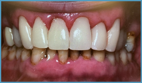 Mouth after whitening the teeth