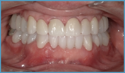 Mouth with all teeth on both arches