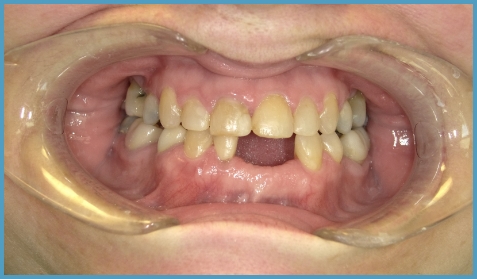 Mouth missing a few lower teeth