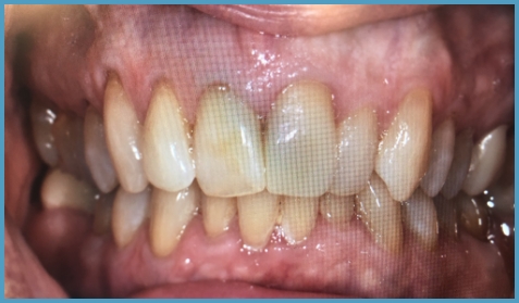 Mouth after restoring chipped tooth