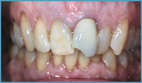 Mouth with a chipped front tooth