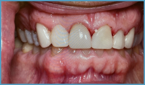 Mouth with whiter teeth