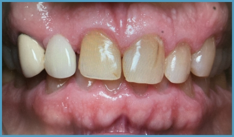 Mouth with discolored teeth