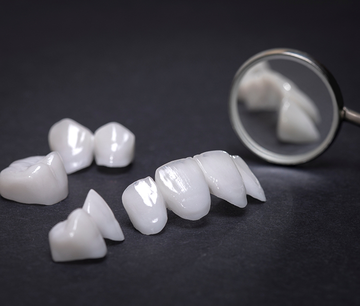Several veneers on a table next to a dental mirror