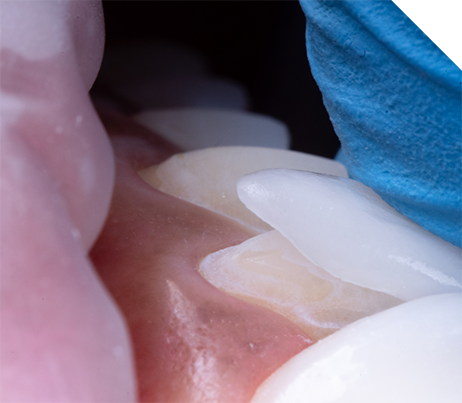 Close up of a veneer being placed over a tooth