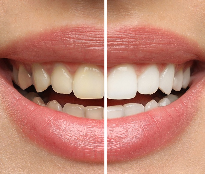 Closeup of a smile that’s half whitened