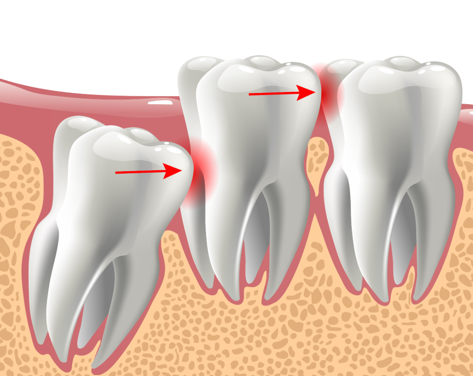Illustrated cross section of wisdom teeth
